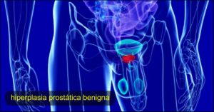 prostata hiperplasia prostática benigna